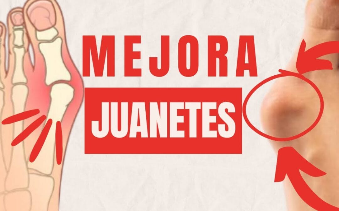 Mejora tus Juanetes