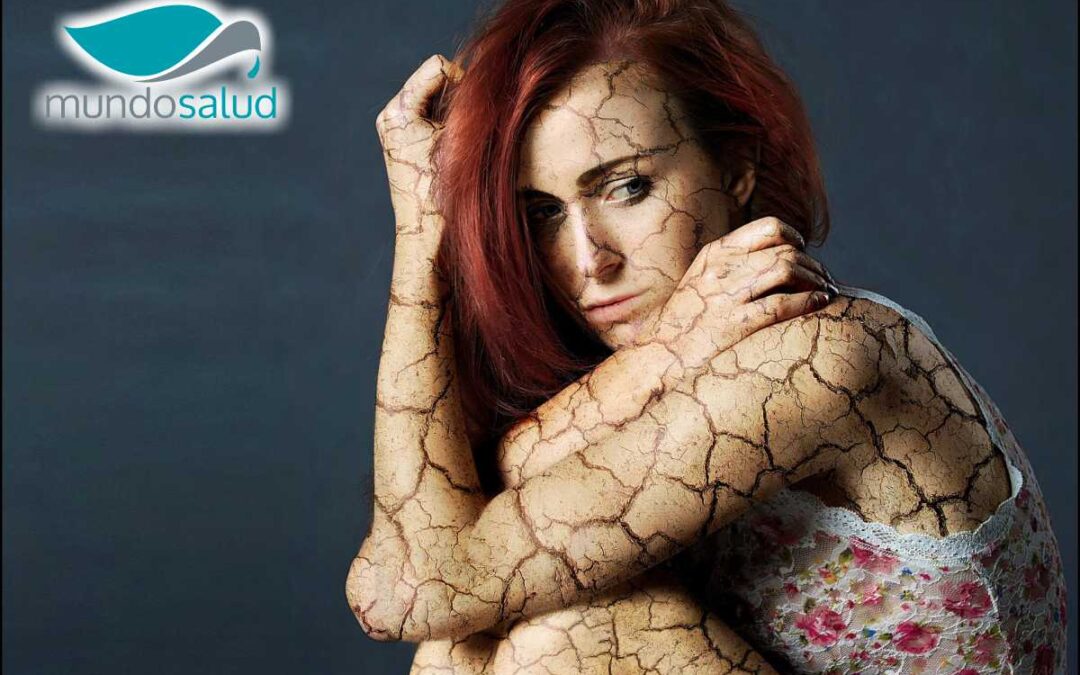 Osteoporosis: La Enfermedad Silenciosa