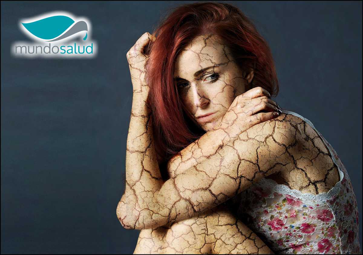 Osteoporosis La Enfermedad Silenciosa